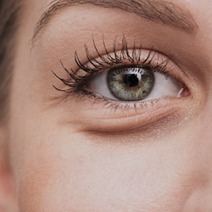 eye bags