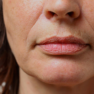 face volume loss