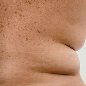 fat reducyion