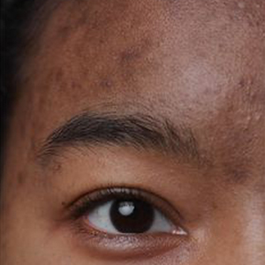 hiperpigmentation