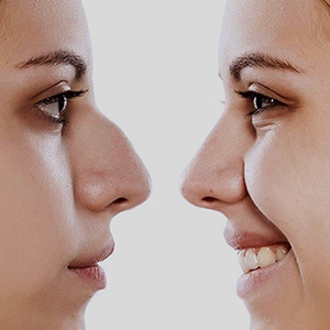 nose shape