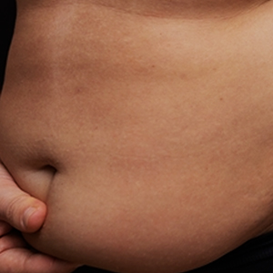 sagging tummy