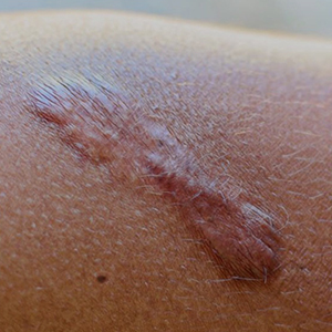 scarring
