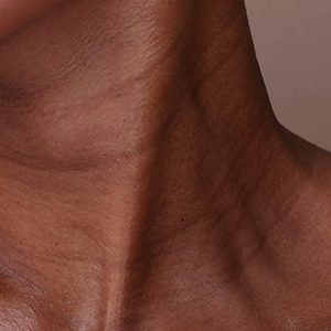 skin laxity