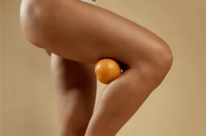 Stretch marks treatment with collagen injections in Dubai - smooth, renew and restore III