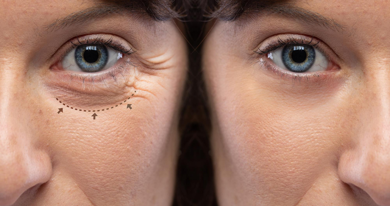 Lower Eyelid Surgery Aftercare: Recovery Tips And Timeline