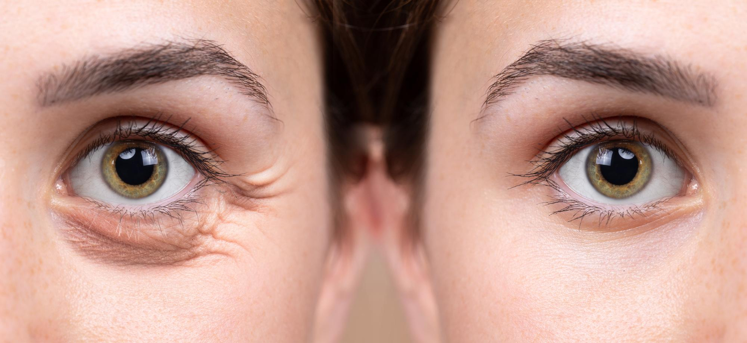 Tips For Fast Recovery After Blepharoplasty In Dubai