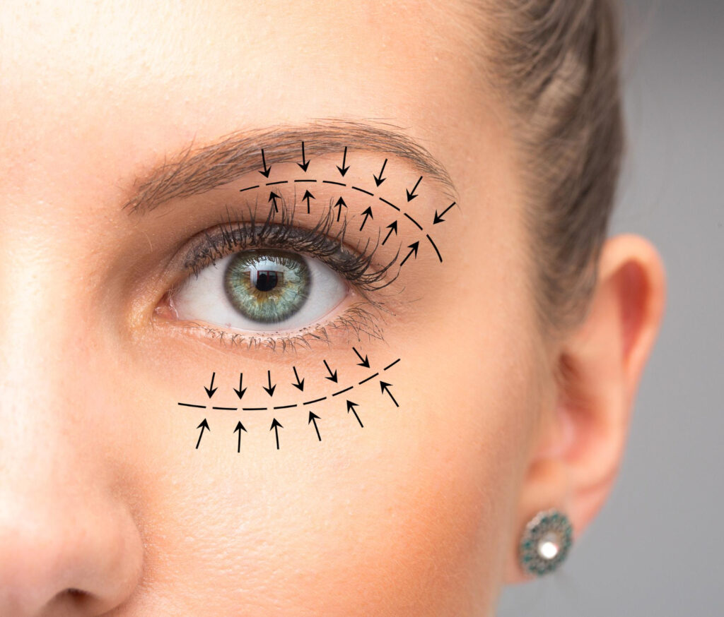 Tips For Fast Recovery After Blepharoplasty In Dubai