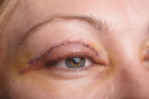 Tips For Fast Recovery After Blepharoplasty In Dubai