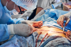 Tummy Tuck Recovery Guide Timeline, Tips, And What To Expect After Surgery